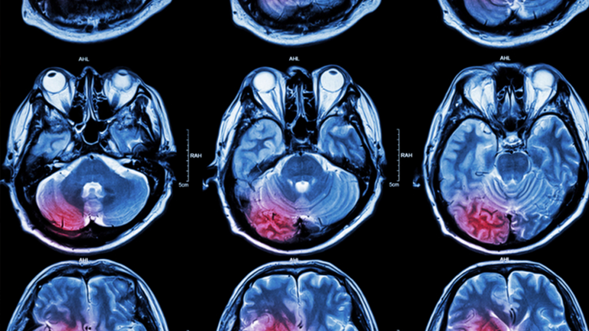 Brain imaging